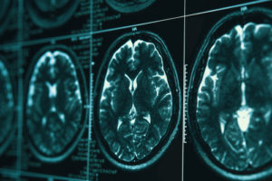 MRI of brain - concussion injury lawyer