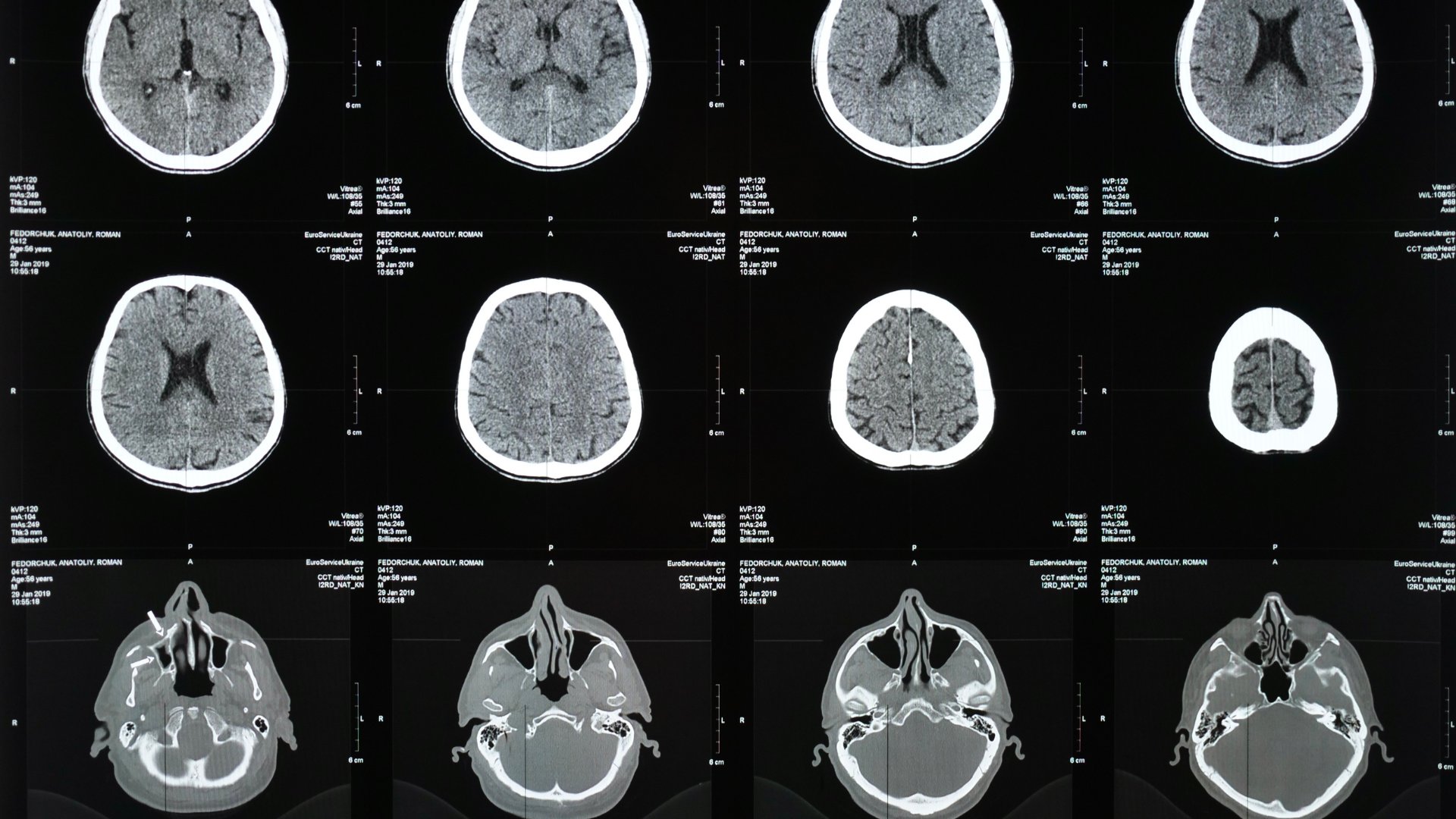 Silver Spring Traumatic Brain Injury Lawyer | Brain Injury Attorneys